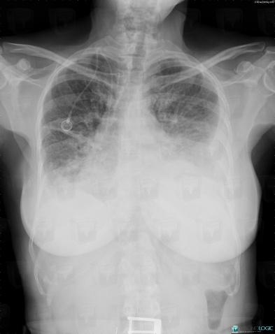 Lymphangitic carcinomatosis, Pulmonary parenchyma, X rays