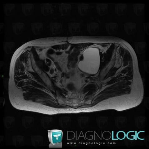 Lymphocele, Adnexa / Ovary fallopian tube, MRI