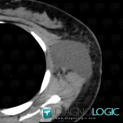 Lymphocele, Chest wall, CT