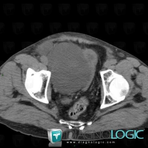 Lymphocele, Pelvis / Perineum, CT