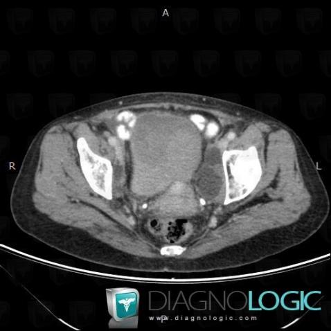 Lymphocele, Pelvis / Perineum, CT
