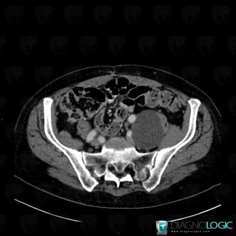 Lymphocele, Retroperitoneum, CT