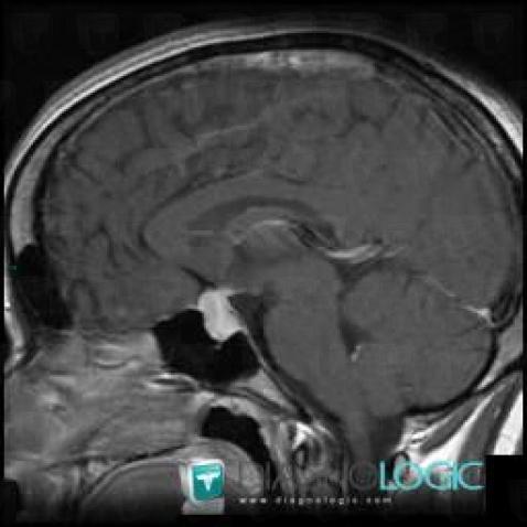 Lymphocytic hypophysitis, Pituitary gland and parasellar region, MRI