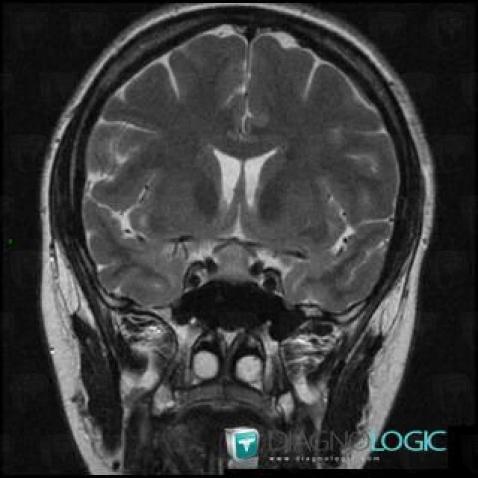 Lymphocytic hypophysitis, Pituitary gland and parasellar region, MRI