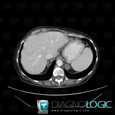 Lymphoma, Adrenal glands, CT