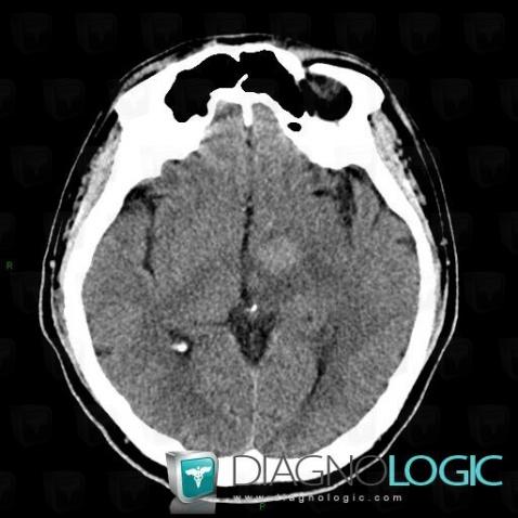 Lymphoma, Basal ganglia and capsule, CT