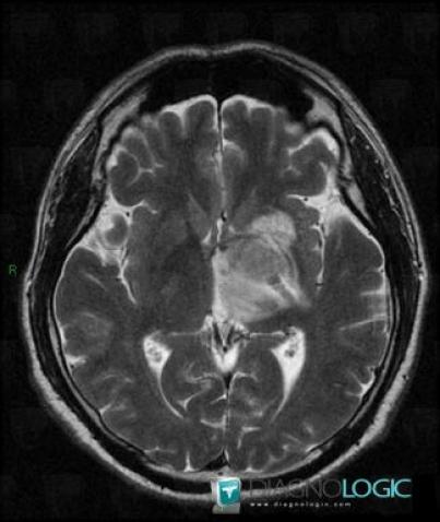 Lymphoma, Basal ganglia and capsule, MRI