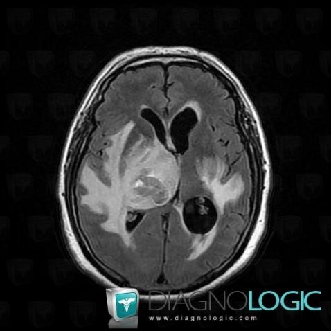 Lymphoma, Basal ganglia and capsule, Ventricles / Periventricular region, MRI