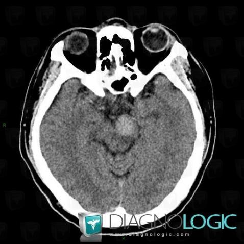 Lymphoma, Brainstem, Posterior fossa, CT