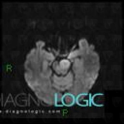 Lymphoma, Brainstem, Posterior fossa, MRI