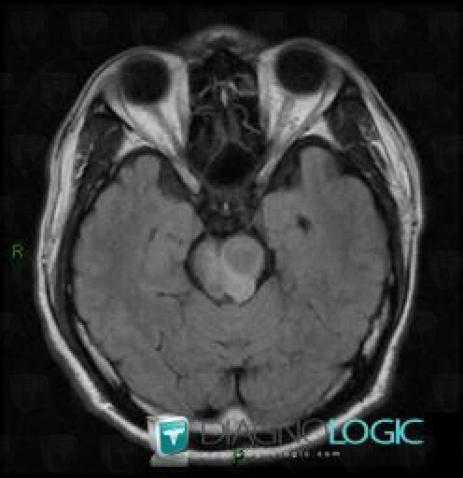 Lymphoma, Brainstem, Posterior fossa, MRI