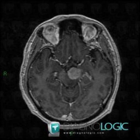 Lymphoma, Brainstem, Posterior fossa, MRI