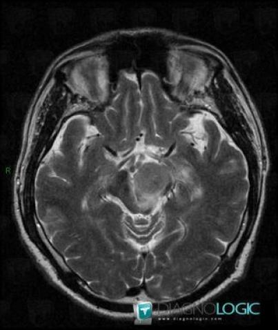 Lymphoma, Brainstem, Posterior fossa, MRI