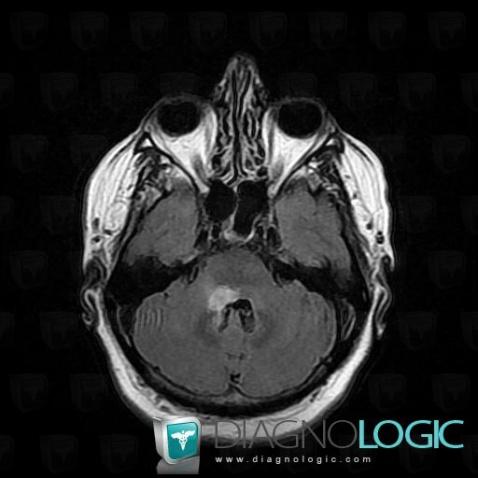 Lymphoma, Brainstem, Posterior fossa, MRI