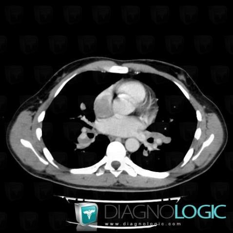 Lymphoma, Cardiac cavities / Pericardium, CT