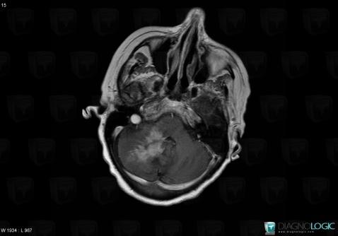 Lymphoma, Cerebellar hemisphere, Posterior fossa, MRI