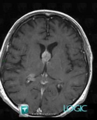 Lymphoma, Cerebral falx / Midline, MRI