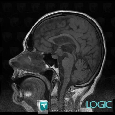 Lymphoma, Cerebral falx / Midline, MRI