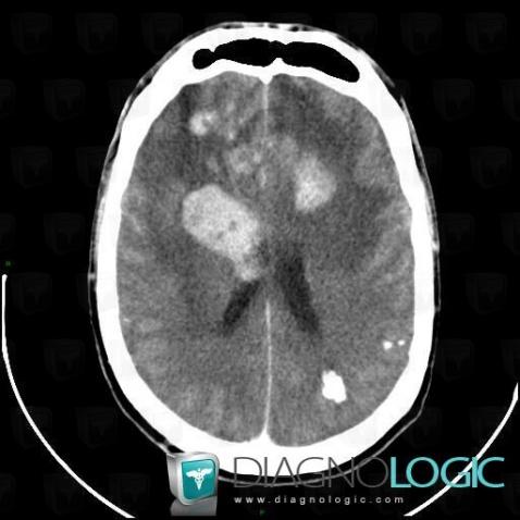 Lymphoma, Cerebral hemispheres, Basal ganglia and capsule, CT