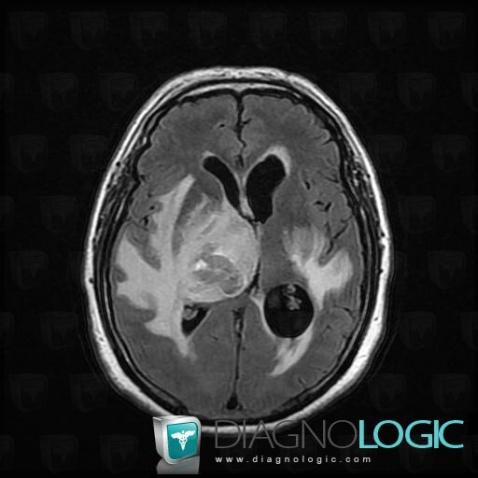 Lymphoma, Cerebral hemispheres, Basal ganglia and capsule, MRI