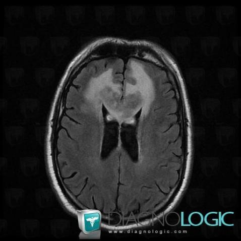 Lymphoma, Cerebral hemispheres, Corpus callosum, MRI