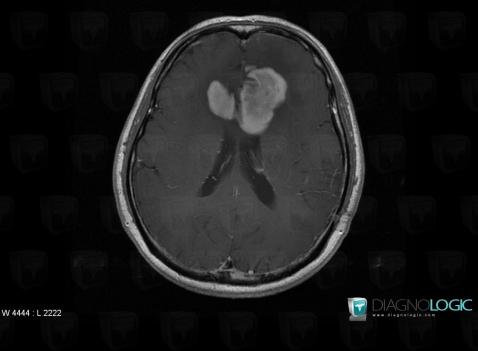 Lymphoma, Cerebral hemispheres, Corpus callosum, MRI