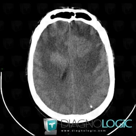 Lymphoma, Cerebral hemispheres, CT