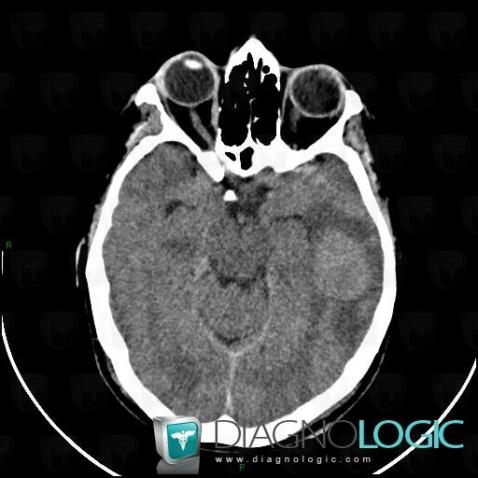 Lymphoma, Cerebral hemispheres, CT