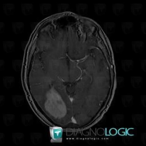 Lymphoma, Cerebral hemispheres, MRI