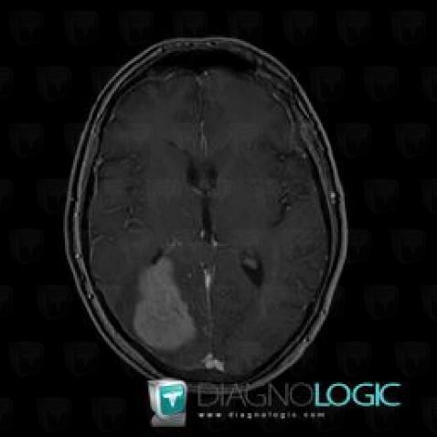 Lymphoma, Cerebral hemispheres, MRI