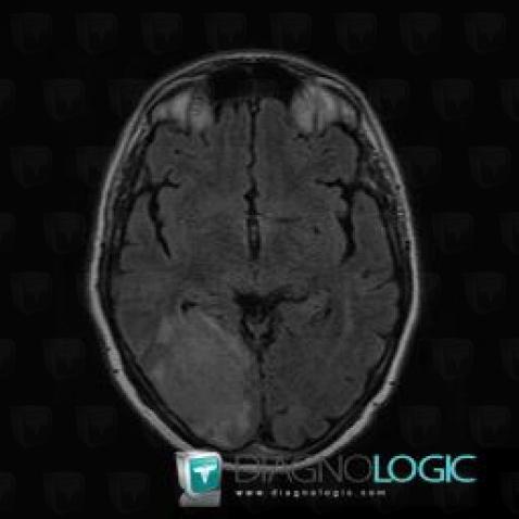 Lymphoma, Cerebral hemispheres, MRI