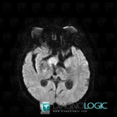 Lymphoma, Cerebral hemispheres, MRI