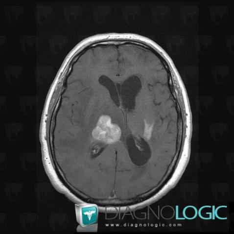 Lymphoma, Cerebral hemispheres, MRI