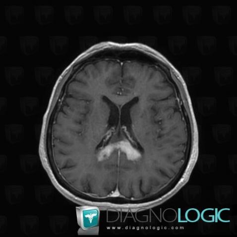 Lymphoma, Cerebral hemispheres, MRI