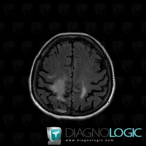 Lymphoma, Cerebral hemispheres, MRI