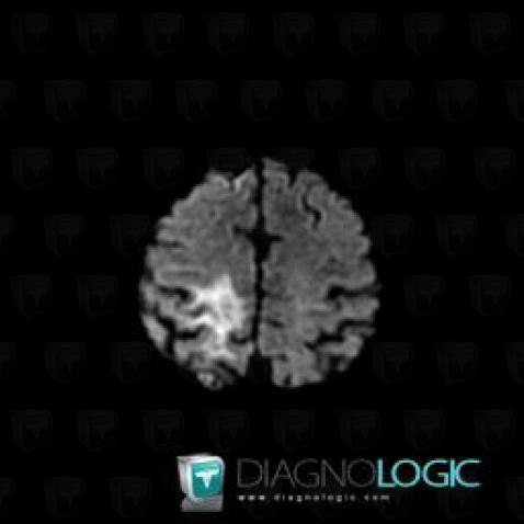 Radiology case : Lymphoma (MRI) - Diagnologic