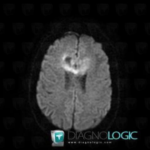 Lymphoma, Cerebral hemispheres, MRI