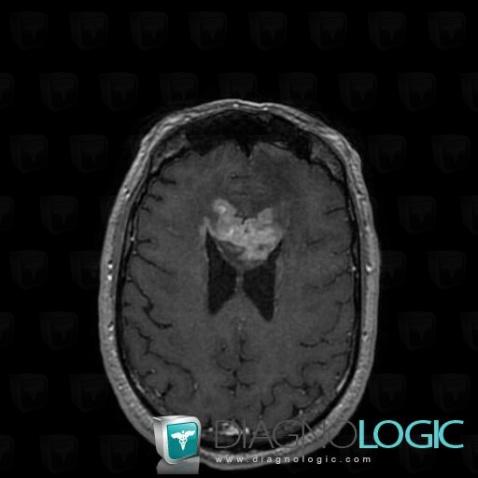 Lymphoma, Cerebral hemispheres, MRI