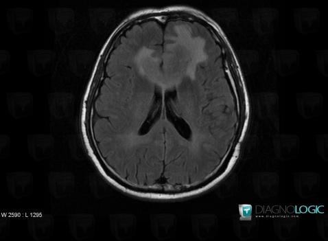 Lymphoma, Cerebral hemispheres, MRI