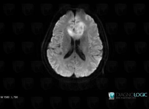 Lymphoma, Cerebral hemispheres, MRI