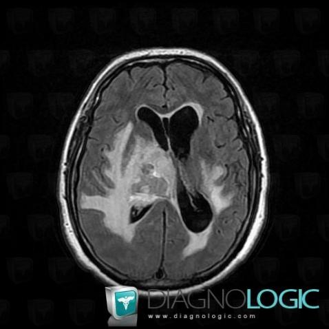 Lymphoma, Cerebral hemispheres, MRI