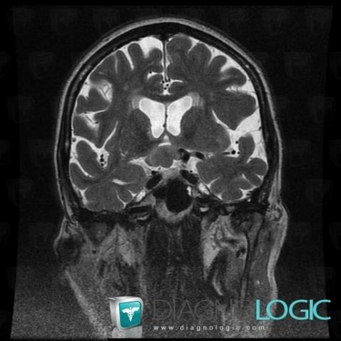 Lymphoma, Cerebral hemispheres, Pituitary gland and parasellar region, MRI