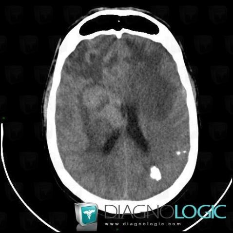 Lymphoma, Cerebral hemispheres, Ventricles / Periventricular region, CT