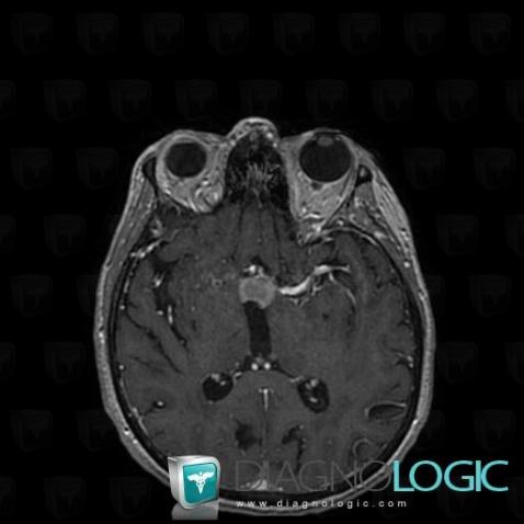 Lymphoma, Cerebral hemispheres, Ventricles / Periventricular region, MRI