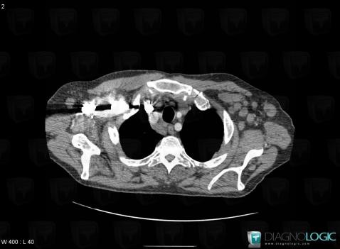 Lymphoma, Chest wall, CT