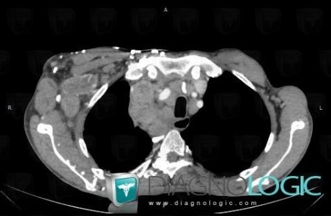 Lymphoma, Chest wall, CT