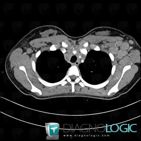 Lymphoma, Chest wall, CT