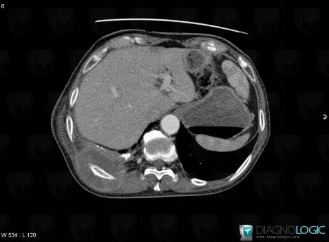 Lymphoma, Chest wall, Ribs, CT