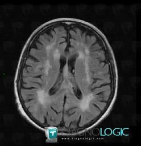 Lymphoma, Corpus callosum, MRI