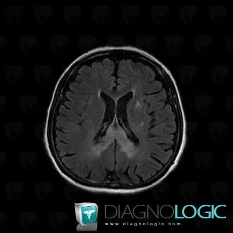 Lymphoma, Corpus callosum, MRI